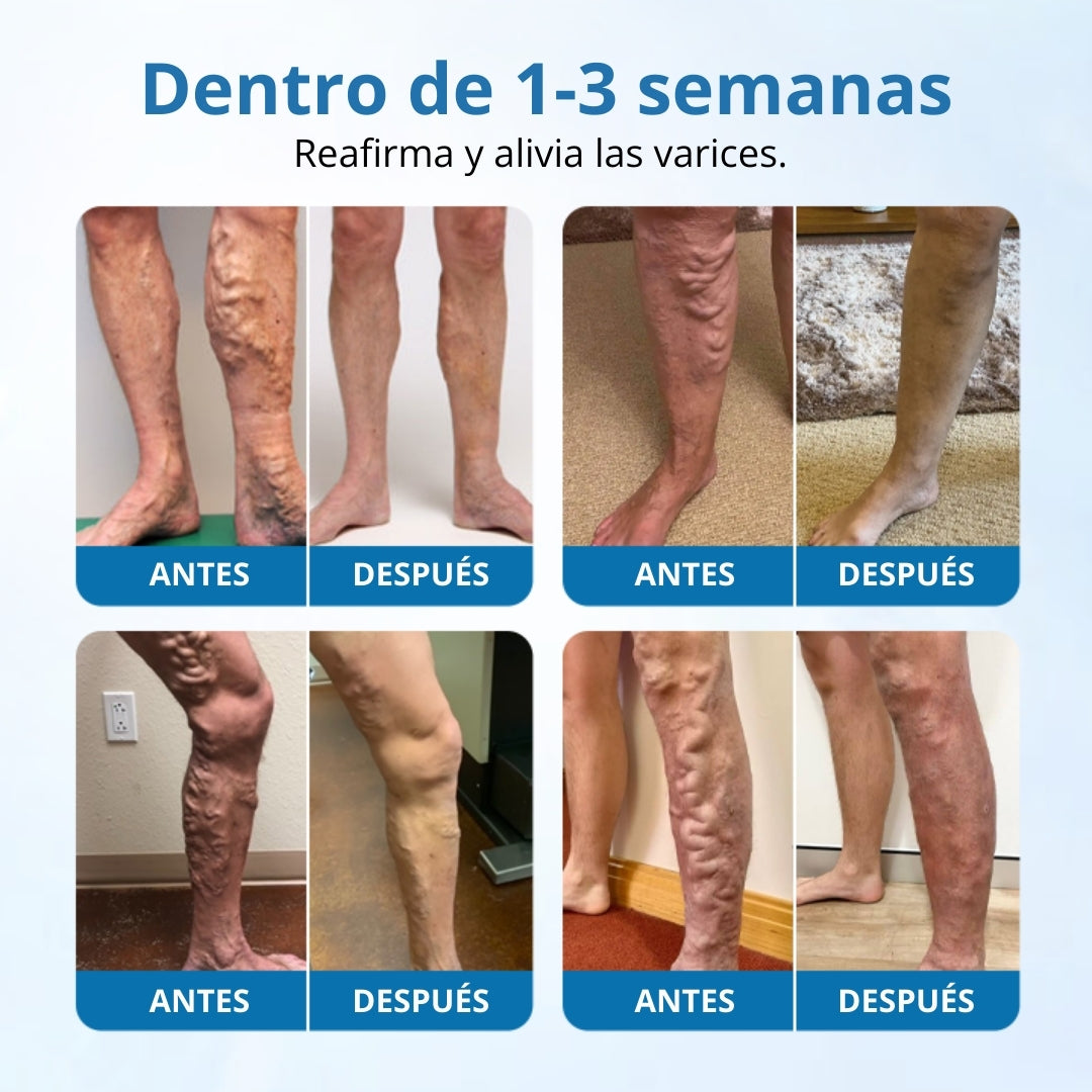 📢Ourlyard® VeinGuard Spray de Hierbas-✅ Clínicamente probado para eliminar las venas varicosas en solo 7 días.