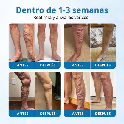 📢Ourlyard® VeinGuard Spray de Hierbas-✅ Clínicamente probado para eliminar las venas varicosas en solo 7 días.